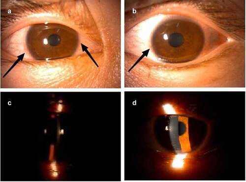 Figure 3. Slit-lamp examination photos on the seventh day after the third dose of COVID-19 vaccination.