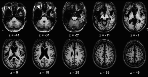 Figure 1. Anatomy of patient GA’s brain on a T1-weighted magnetic resonance image, normalized to MNI space using the clinical toolbox implemented in SPM8 (www.fil.ion.ucl.ac.uk/spm).