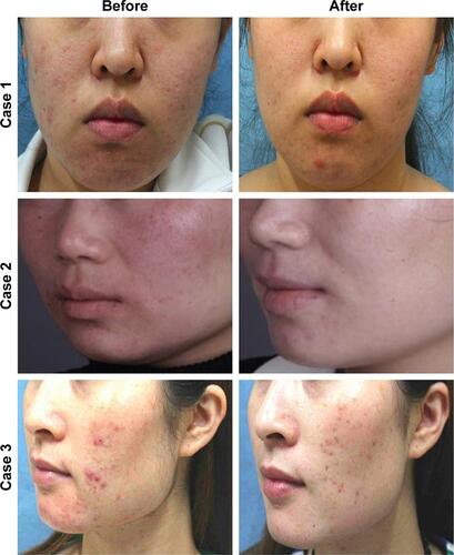 Figure S1 Contrast figures of three cases treated with glycolic acid.