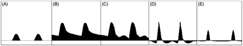 Figure 4. Schematic representation of the main phases of cavernosal artery waveform during a penile Doppler ultrasound examination. (A) In basic conditions, the waveform appears hardly detectable in a velocity/time curve. (B) A few minutes after injection of alprostadil, the cavernosal artery inflow becomes well detectable. (C) The waveform continues to modify with increasing peak systolic velocity (PSV, cutoff >35 cm/s) and decreasing end-diastolic velocity (EDV, cutoff <5 cm/s), until the systolic velocity peaks, indicating the grade of arterial inflow. Acceleration time (AT, cutoff <100) narrows, and can be measured from the bottom to the top of the peak. (D) Later, diastolic flow reversal is shown, indicating an intact venous occlusion mechanism. (E) Intracavernosal pressure exceeds systolic pressure at maximal tumescence, causing reduction in the systolic velocity and narrowing of the systolic peak.