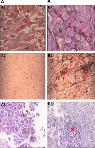 Figure 5 Comparison of tumor fibrosis after UMIPIC as shown by EM.