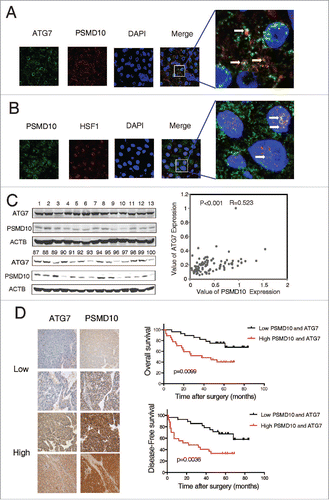 Figure 7. The relationship between PSMD10 and ATG7 in the clinical samples. (A, B) The liver tumor frozen sections from 2 patients were performed by immunofluorescence analysis to detect the localization of PSMD10 and ATG7 (A) or HSF1 (B). DNA was stained by DAPI. Representative confocal microphotographs are shown together with profiles of colocalization within the area of interest (yellow signals merge), and higher-magnification images of the outlined areas are also shown. (C) Proteins were extracted from 100 patients with HCC for immunoblot with anti-PSMD10 or anti-ATG7 antibody. The protein bands were analyzed by ImageJ2x software and the relative band intensity was normalized to ACTB band. Representative samples are shown (left panel). Correlation of expression level of PSMD10 and ATG7 is shown (right panel). (D) Representative PSMD10 and ATG7 expression in TMA sections of 117 patients with HCC (original magnification 200 ×; left panel). The median value for PSMD10 and ATG7 expression in HCCs was used to divide the patients into high (above median) and low (below median) PSMD10 and ATG7 groups. The disease-free and overall survival rates were compared between the low PSMD10 and ATG7 expression group (n = 28) and the high PSMD10 and ATG7 expression group (n = 27; right panel).