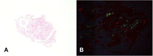 Figure 1. (A) Hematoxylin and eosin stain of core needle biopsy of subcutaneous soft tissue mass (4×). (B) Polarized Congo red stain of tissue from core needle biopsy of subcutaneous soft tissue mass (10×).