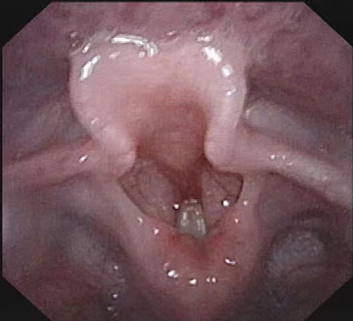 Figure 1 Bilateral vocal cord paralysis.