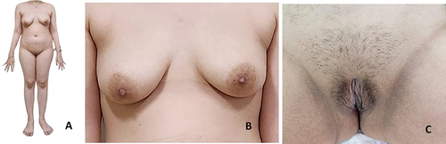 Figure 1 Patient’s physical stature. (A) Patient has normal stature with height 170 cm; (B) Breast development shows Tanner 5; (C) Pubic hair development shows Tanner 4.