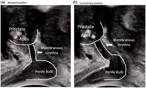 Figure 2. Preoperative transperineal ultrasound (TPUS) images for a single patient a) at rest and b) during voluntary pelvic floor muscle contraction. The anterior/superior displacement of the apex of the prostate, dorsal compression of the membranous urethra by the action of the striated urethral sphincter and compression of the penile bulb (BU) during the cine-loop image sequences was used to identify and/or confirm the prostatic apex, membranous urethra and the BU for the measurement of membranous urethral length using TPUS.