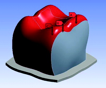 Figure 3. Vertical loading force of 250 N. Mesial loading of 250/3 N (A). Central loading of 250/3 N (B). Distal loading of 250/3 N (C).