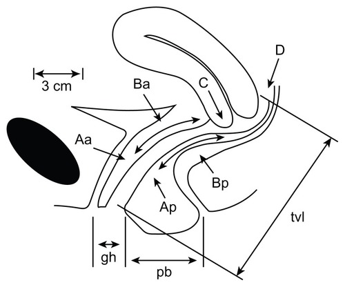 Figure 1 Points and landmarks for Pelvic Organ Prolapse Quantification system examination.
