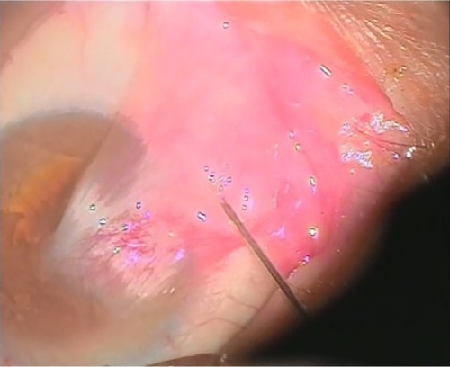 Figure 1 Subpterygium injection of MMC and bevacizumab by insulin syringe under topical anesthesia.