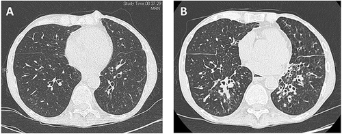 Figure 1 Chest CT scan just after transplant (A) and at one-year post-transplant (B). Chest CT scan showed normal bronchi and parenchyma after transplant (A). At one-year post-transplant, the imaging shows diffuse airway wall thickening, bronchiectasis, mucus plugging, and some sub-bronchial consolidations (B) related to chronic bronchopulmonary infection.
