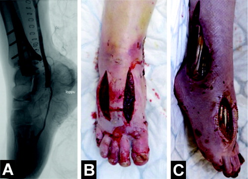 Figure 4. A. Occlusion of the peroneal artery was bypassed with a vein graft, and control angiography of the bypass graft showed blood flow to the plantar and digital arteries. B. Fasciotomies were performed due to the risk of compartment syndrome following revascularization. C. Despite the bypass, the patient developed severe ischemic damage, resulting in persistent foot pain and extensive soft tissue necrosis.
