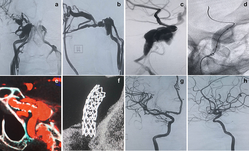 Figure 1 A 56-year-old woman with a right carotid-cavernous sinus fistula (CCF) of the ICA. (a and b) Right ICA angiography shows a direct high-flow CCF that was drained by the superior ophthalmic vein. (c and d) Transportation of the Willis covered stent (WCS) to the fistula and dilation of the balloon. (e and f) DynaCT showed a completely inflated stent. (g and h) Immediate angiography after deployment of the WCS showed occlusion of the fistula and preservation of the internal carotid artery.