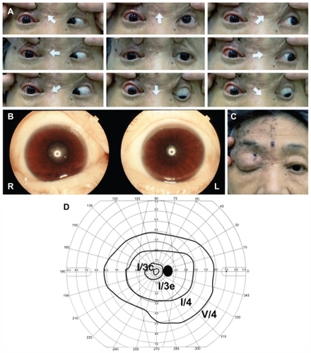 Figure 1 Photographs of eye positions in all directions, and the pupils and face of our patient before treatment. (A) Photographs of eye positions in all directions. Complete ophthalmoplegia and ptosis can be seen on the right side. (B) Photographs of pupils under standard room lighting. Anisocoria can be seen and the right pupil is dilated. The light reflex is absent. (C) Photograph of the face. Mixed vesicular and crusted eruptions can be seen along the first division of the trigeminal nerve. Complete ptosis is present in the right eye. (D) Goldmann kinetic perimetry. Slight constriction of the visual field was detected in the right eye.