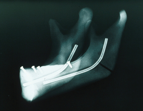 Figure 3. X-ray of the phantom model. Four titanium screws in the alveolar bone act as reference markers.