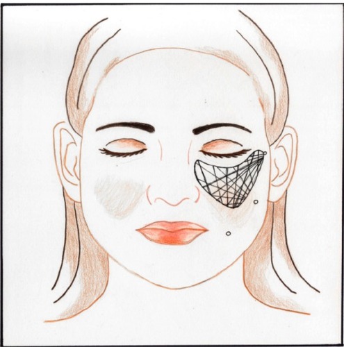 Figure 7 Drawing of face demonstrating crosshatch pattern.