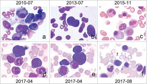 Figure 1. Bone marrow cytomorphologic examination: a. Bone marrow primarily showed active hyperplasia, granulocyte cytoplasm particles increased and common bloodthirsty cells in the July 2010. b. Reexamination of bone marrow due to negative outcome of chemotherapy for MCD showed the same with the last which not suggested hematological malignancies in July 2013. c. In November 2015 the bone marrow showed Active bone marrow hyperplasia, mature plasma cells increased, accounting for 7.0%. d and e. In April 2017, the patient came to hospital due to fever with pancytopenia and bone marrow showed plasma cells obviously increased with 29.5%, and proplasmacyte seen, which can be diagnosed MM accompanied with other examination. f. After therapy, Reexamination of bone marrow was positive with the plasma cells decrease to 3.5% in August 2017.