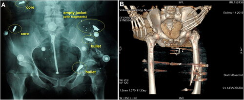 Figure 3. (A) Representative standard pre-autopsy X-ray image allowing identification of various kinds of intracorporeal ballistic material. (B) Representative 3D-reconstructed pre-autopsy CT imaging lacking precision for identifying the various kinds of intracorporeal ballistic material.