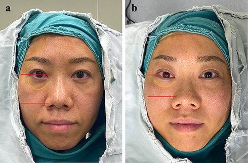 Figure 1 A 39-year-old female patient. (a) Patient in upright position exhibiting flat malar mound, greater lid-cheek distance (yellow line), prominent nasolabial folds, mid-cheek grooves, and jowl fat; (b) Patient in supine position showing a fuller malar mound, shortened lid-cheek distance, and improvement in the mid-cheek grooves and nasolabial folds. The distance from the pupil to the most projected point of the mid-face is shorter (red lines), indicating elevation and augmentation of malar mound.