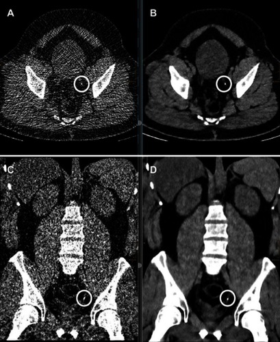 Figure 1 Unenhanced low-dose CT of the abdomen. A 30-year old, male patient with BMI of 36. Effective dose: 1.62 mSv. (A, C) Severe image noise resulting in restricted interpretation on axial and coronal reformation with FBP). (B, D) Same patient with iterative model-based reconstruction (IMR). Concrement (1 mm) encircled in the distal ureter on the left side, only clearly visible on IMR image set.