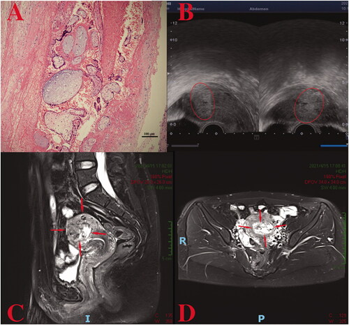 Figure 4. (A) A partial hydatidiform mole in the second case: decidual-like tissues, villus edema, no obvious hyperplasia of the trophoblastic cells; (B) Ultrasound examination showed an irregular hyperechoic area in the uterine cavity (sagittal view on the left, coronal view on the right); Space-occupying intramural lesions were observed on the left side of the uterine fundus (C, D).