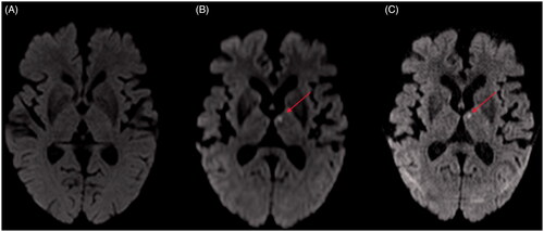 Figure 2. Patient presented with sudden onset right-sided numbness and no other deficits. Routine computed tomography (CT) was normal. A: Diffusion-weighted (1.5 T) magnetic resonance imaging (DWI-MRI) was normal. B,C: High resolution 3 T MRI (DTI and DWI-isotropic voxels) revealed left thalamus infarction.