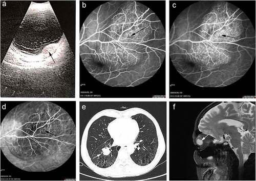 Figure 1. Ocular and medical imaging examination of pre-immunotherapy. (a) Ocular ultrasonography. (b) The early stage of FFA. (c) The late stage of FFA. (d) ICGA of fundus. (e) Chest high-resolution CT. (f) MRI of brain