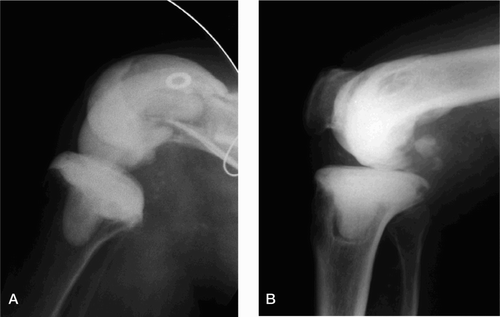 Figure 4. Flexion over 90° in the same patient (A) and over 75° in another case (B).
