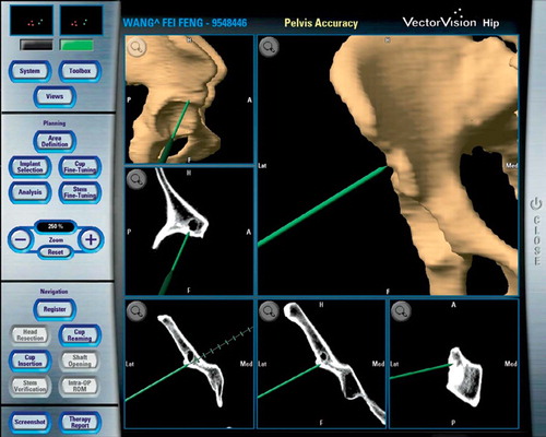 Figure 4. The planning and execution of the osteotomy can be performed under real-time, continuous guidance by either the original CT data or a reconstructed 3-D model.