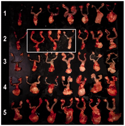 Figure 6. Macroscopic observation of ex vivo RTs (including tumor) 16 days after tumor inoculation. (1) Infusion of Car2/gel; (2) infusion of Car5/gel; (3) intravenous injection of carboplatin; (4) infusion of blank gel; (5) control group. White box indicates the three RTs without tumor formation/recurrence in mice of Car5/group.