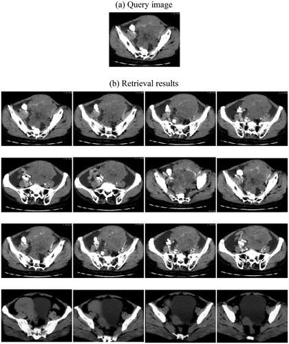 Figure 7. Experimental results for pelvic CT image.