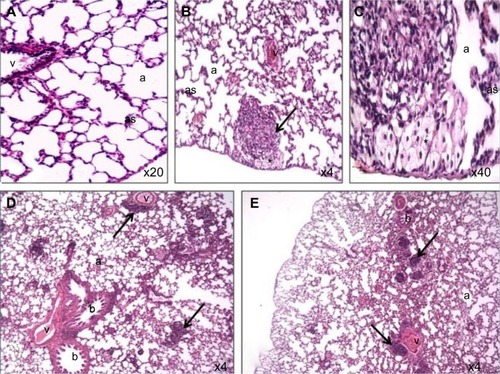 Figure 4 Photomicrograph of lung tissue sections of rats treated with Ni nanoparticles.Notes: (A) control (200X); (B) lymphocytic and eosinophilic infiltrates with thickening of alveolar walls and foamy macrophages (dark arrow) with the 20 mg/kg dose of Ni nanoparticles (40X); (C) foamy macrophages (indicated by the asterisk) with 20 mg/kg Ni nanoparticles (400X); (D) lymphocytic and eosinophilic infiltrates (dark arrow) with 1 mg/kg Ni nanoparticles (40X); (E) lymphocytic and eosinophilic infiltrates (dark arrow) with 10 mg/kg Ni nanoparticles (40X).Abbreviations: a, alveolar space; as, alveolar septae; b, bronchioles; Ni, nickel; v, veins.