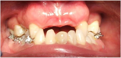 Figure 6 Orthodontic treatment was instituted.
