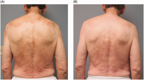 Figure 2. Representative Clinical Photographs of a Patient with CPUO Treated with Dupilumab. (A) Excoriations on Back Prior to Dupilumab Treatment. (B) Visibly Cleared Back with Faint Erythema After Treatment for 4 Months with Dupilumab.