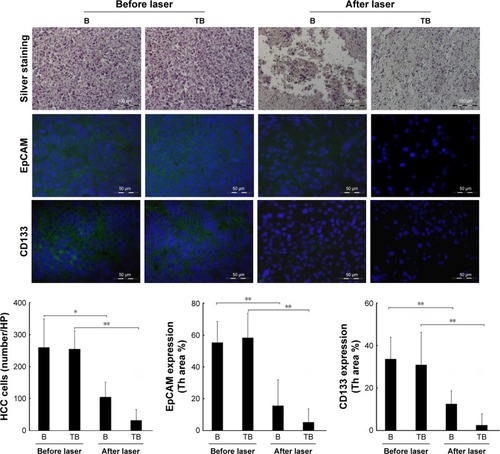 Figure 6 Upper: Quantification of HCC cell-killing in the tumor tissue by silver staining.Notes: Middle and lower: Identification and quantification of cancer stem cell surface markers EpCAM and CD133 by immunofluorescence staining. Blue: DAPI-positive staining of nuclei in the tumor tissue. Green: positive staining of EpCAM and CD133. B (bomb): Adr/GNRs@PMs; TB (targeting bomb): Adr/GNRs@PMs-antiEpCAM. *P<0.05, **P<0.01.Abbreviations: Adr, Adriamycin; EpCAM, epithelial cell adhesion molecule; GNR, gold nanorod; HCC, hepatocellular carcinoma; PM, polymeric nanomicelles.