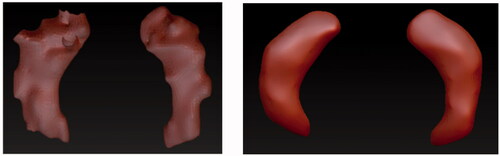 Figure 14. Fixing model imperfections of segmented data of the control brain. Images show the models before (left) and after (right) the processing in the healthy hippocampus.