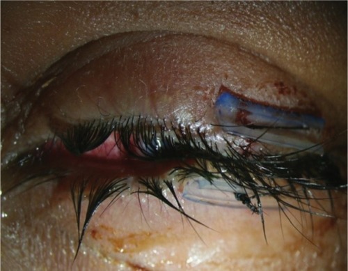 Figure 4 Left eye post lateral tarsorrhaphy.