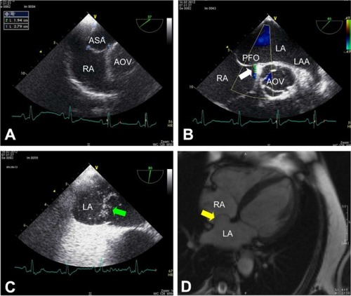 Figure 2 Transesophageal echocardiogram and cardiac magnetic resonance imaging (MRI). (A)Transesophageal short-axis view at 37° confirms the giant ASA with an excursion into the RA of 19 mm and a base diameter of 28 mm. (B) Transesophageal short-axis view (46°) shows a left-to-right shunt through a small PFO (white arrow) as detected by color Doppler. (C) Using agitated gelafundin (4%) intravenously some microbubbles (green arrow) can be demonstrated in LA during Valsalva maneuver indicating a right-to-left shunt through the small PFO in case of elevated intrathoracic pressure (transesophageal short-axis view at 80°). (D) Cardiac MRI (transverse plane) also reveals a huge ASA with protrusion into the RA (yellow arrow).