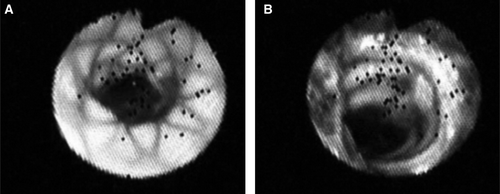 Figure 4.  Illustration in endoscopy of the luminal surface of the stent-grafts. (A) distal end of the transrenal stent constriction in a stent-graft; (B) constriction at the anchorage of Module B in Module A with variable levels of thrombotic anchorages in a stent-graft.