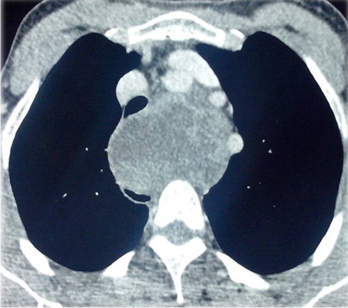Fig. 2 Computed tomography chest scan (axial section) after iodinated contrast: a liquid mass of the middle mediastinum, well-limited, heterogeneous, repressing trachea and supra-aortic trunks without invasion signs.