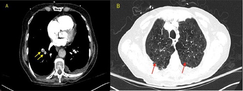 Figure 1. CT chest pulmonary embolism protocol on day 1. (a): Multiple small bilateral pulmonary emboli (yellow arrows in a). Elevated RV to LV ratio of 1.4 indicative of right heart strain. (b): Bilateral lower lobe patchy consolidation. Small patchy ground glass opacity in the right upper lobe (Red arrows in b). Extensive emphysema