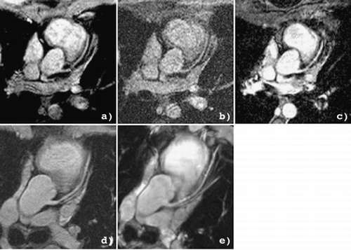 Figure 1. LAD images from two healthy volunteers at 1.5 T and 3.0 T.