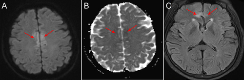 Figure 1 The patient 8 and 4. The MRI results of patient 8 showed high DWI ((A), red arrow) and low ADC ((B), red arrow) in the Cingulate gyrus; The MRI results of patient 4 showed high FLAIR in the isolated bilateral frontal lobe ((C), red arrow).