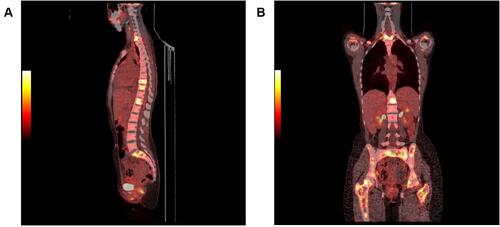 Figure 2 (A) PET scan showing with multifocal bone involvement of the vertebral column. (B) PET scan showing multifocal bone involvement pelvis, femur, vertebra, and scapulae.