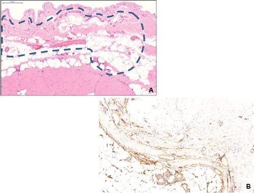 FIGURE 3. A: Low power micrograph of the capsule (haematoxylin-eosin staining, slide scanning, scale bar: 200 μm). Perforating vessels in the connecting tissue between striated muscle and capsule (dashed line). B: CD34-positive structures in the capsule (immunohistochemistry for CD34, counterstaining with haematoxylin, CD34-positive parts appear brown).
