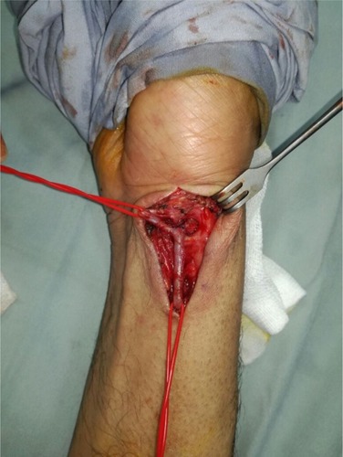 Figure 4 End-to-end anastomosis of the distal radial artery.