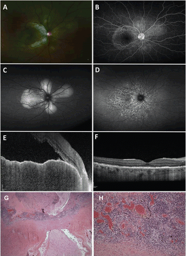 FIGURE 1  A 39-year-old male presented with blurred vision and loss of accommodation in the right eye 1 month after suffering a ruptured globe from facial trauma in the left eye. (A, B) Right eye. Dilated fundus examination showed mildly hyperemic optic nerve associated with exudative retinal detachment in the posterior pole (A) as well as multiple pinpoint areas of leakage on wide-field fluorescein angiography (B). (C, D) Right eye. Wide-field fundus autofluorescence revealed a petaloid pattern of hyperautofluorescence centered on the optic nerve corresponding to areas of exudative retinal detachment (C) at initial presentation that would later evolve to speckled areas of hyper- and hypoautofluorescence resembling leopard spots (D) following resolution. (E, F) Right eye. Enhanced depth spectral domain optical coherence tomography demonstrated a massively thickened choroid measuring more than 500 μm, irregularity of the retinal pigment epithelium, submacular fluid accumulation, disruption of the IS-OS line, and hyperreflective spots within the area of subretinal fluid accumulation (E). Three months following treatment, there was restoration of the normal foveal contour with some residual focal areas of photoreceptor loss (F). (G) Left eye. There is diffuse choroidal thickening with sheets of lymphocytes focally interrupted by nests of epithelioid histiocytes (1.25×, hematoxylin & eosin). No Dalén-Fuchs nodules were identified. (H) Left eye. Monomorphic lymphocytic infiltration of the choroid with occasional nests of epithelioid histiocytes (20×, hematoxylin & eosin). Note that the lymphocytic infiltrate involves the choriocapillaris.