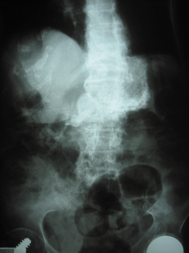 Fig. 2.  Abdomen X-ray of case 2 patient.