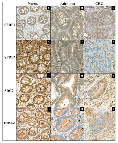Figure 5. Immunohistochemical staining of SFRP1, SFPR2, SDC2, and PRIMA1 on representative colonic biopsy specimens. Immunohistochemical analyses were performed to determine the protein expression changes of SFRP1 (A, B, C), SFRP2 (D, E, F), SDC2 (G, H, I), and PRIMA1 (J, K, L) in normal, colorectal adenoma, and cancer samples. Decreasing protein levels of all 4 markers were observed along the colorectal adenoma-carcinoma sequence. Digital microscopy images, 30 x magnification; scale bar: 50 μm.