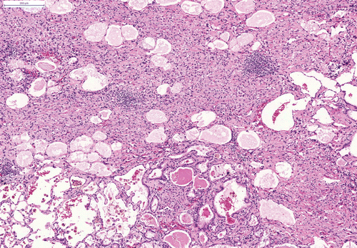 Figure 4.  Severe fibrosis, inflammation and bronchiolo-alveolar hyperplasia after a single intratracheal instillation of Quartz DQ12. H&E, × 50.