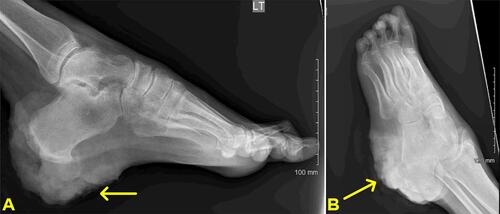 Figure 2 (A and B) Foot X-ray in anteroposterior view (A) and oblique view (B) showing lesion in the lateral posterior calcaneus with surrounding large irregular soft tissue radiopacity/mass. There was no bone resorption that may suggest osteomyelitis.